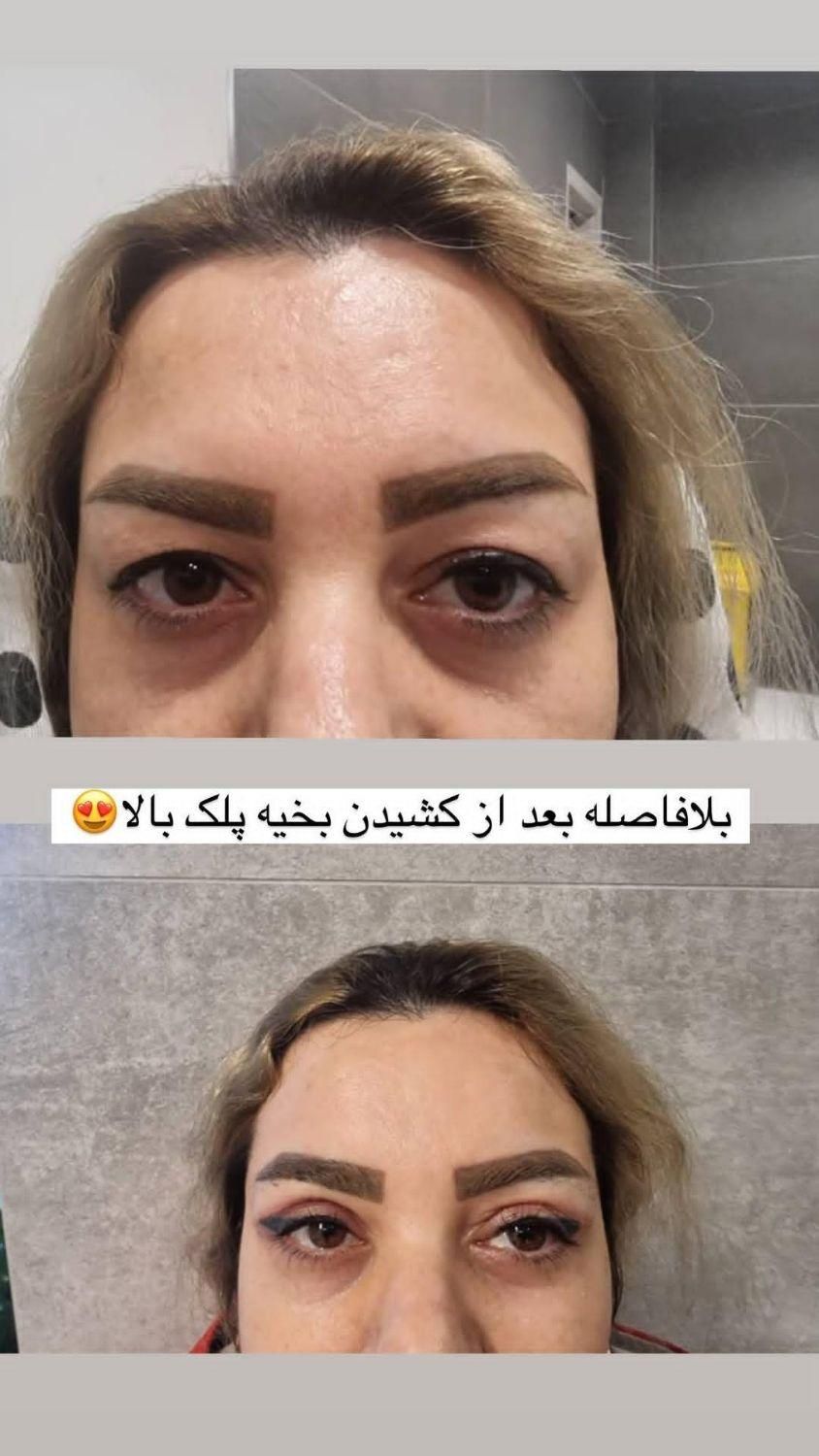 عمل زیبایی گوش (اتو پلاستی)وپلک (بلفاروپلاستی)|خدمات آرایشگری و زیبایی|شیراز, فرهنگ شهر|دیوار