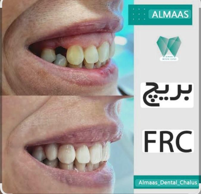 خدمات دندان بریچ frc جایگزین ایمپلنت|خدمات آرایشگری و زیبایی|اهواز, کیانپارس |دیوار