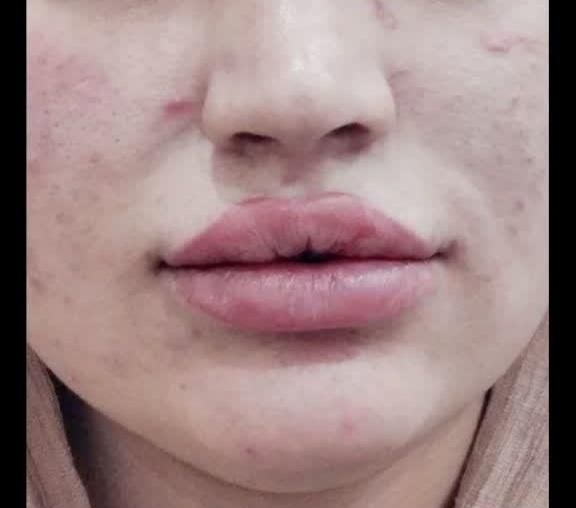 تزریق ژل لب.گونه.چانه.زاویه سازی فک.آنزیم بینی|خدمات آرایشگری و زیبایی|اردکان, |دیوار