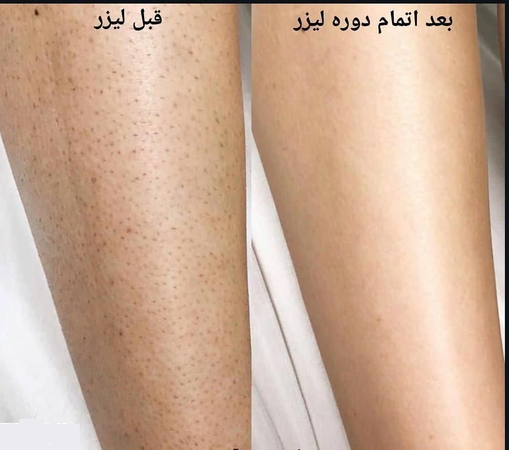 لیزر موهای زائد و الکترولیز|خدمات آرایشگری و زیبایی|فولادشهر, B5|دیوار