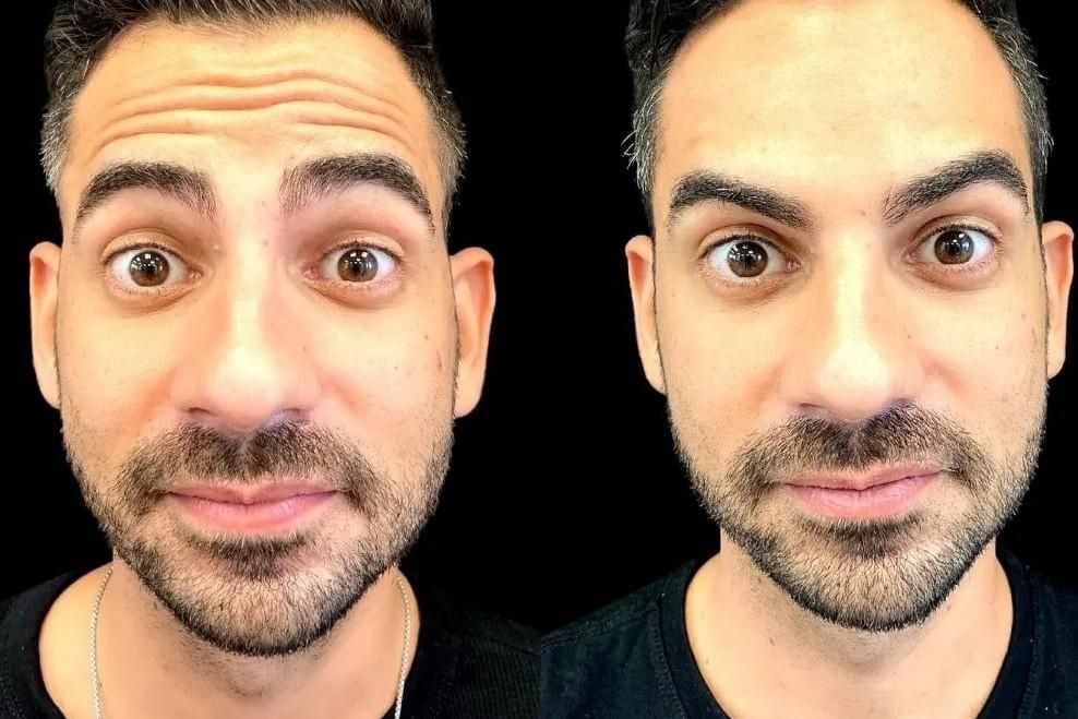 تزریق ژل وبوتاکس،پریسنگ،ارایش دائمصورت تاتوکل صورت|خدمات آرایشگری و زیبایی|گنبد کاووس, |دیوار