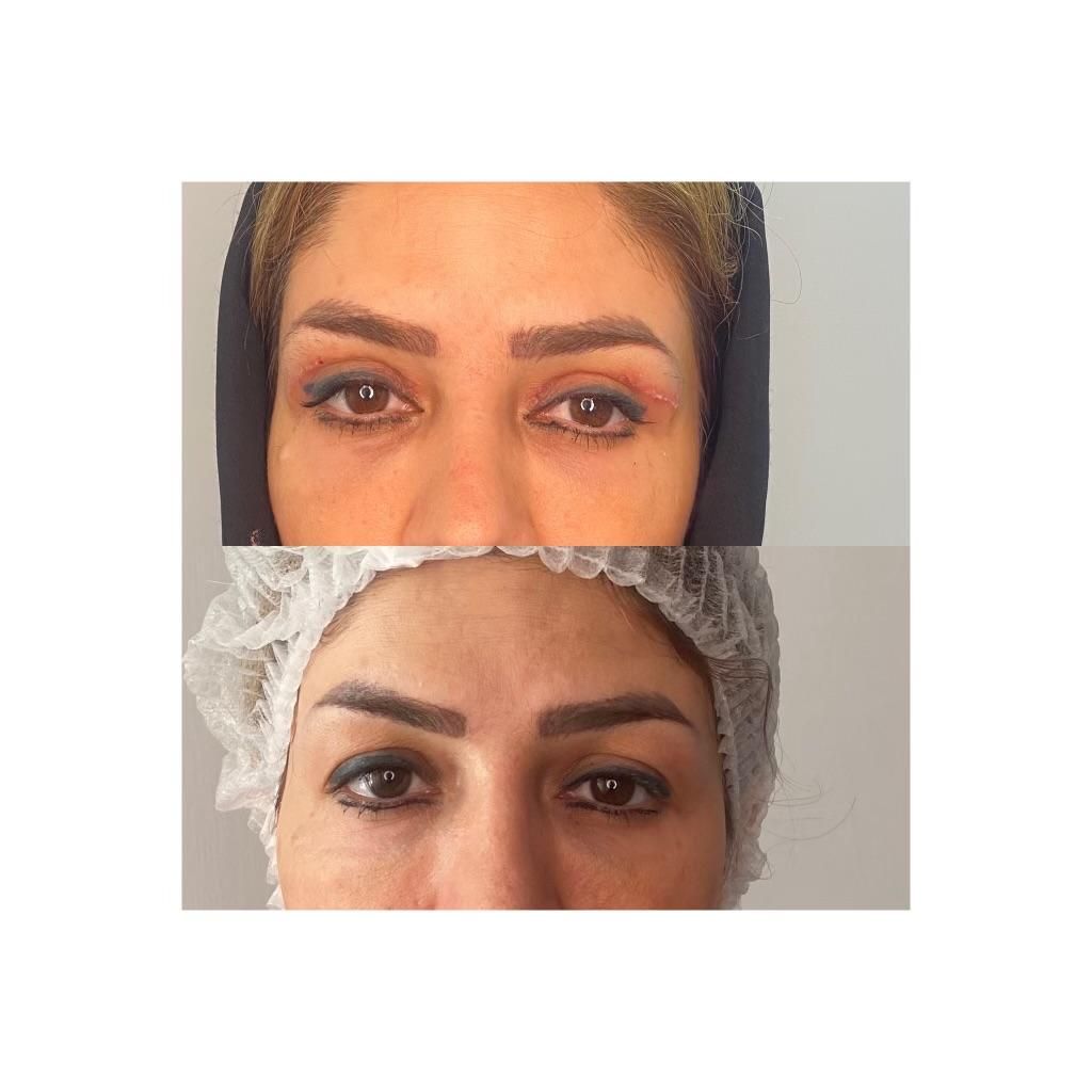 بوتاکس صورت ومعده ژل تزریق چربی عمل پلک ساکشن غبغب|خدمات آرایشگری و زیبایی|یزد, |دیوار