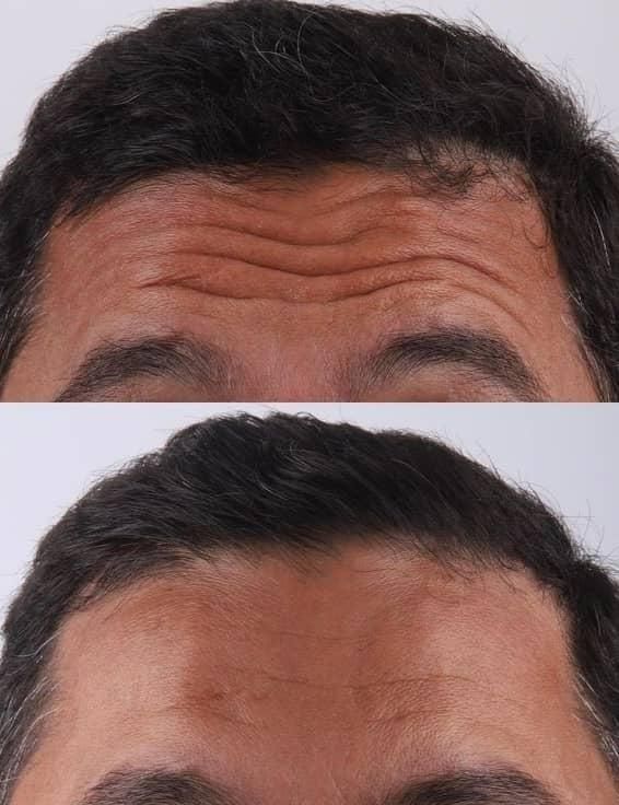 ژل فیلر بوتاکس مزو هایفو لب|خدمات آرایشگری و زیبایی|اسلامشهر, شهرک قائمیه|دیوار