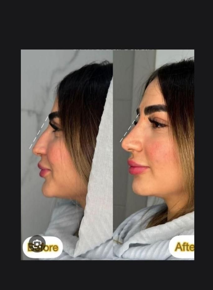 طراحی لیفت بینی وفرمدهی عملی(بدون جراحی)پزشک متخصص|خدمات آرایشگری و زیبایی|مشهد, سناباد|دیوار