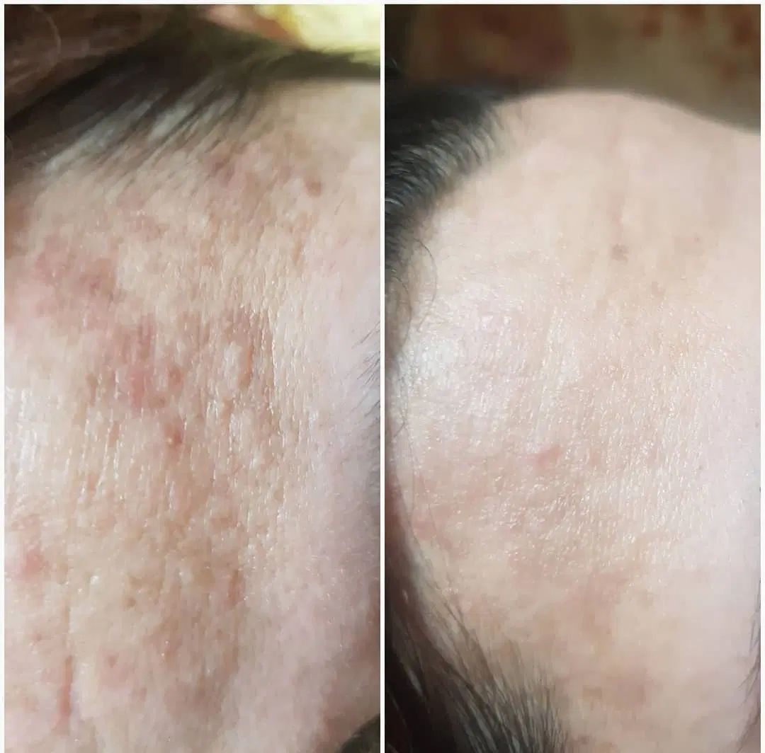 جوانسازی صورت با بهترین متریال و بروز ترین دستگاه|خدمات آرایشگری و زیبایی|گرگان, |دیوار