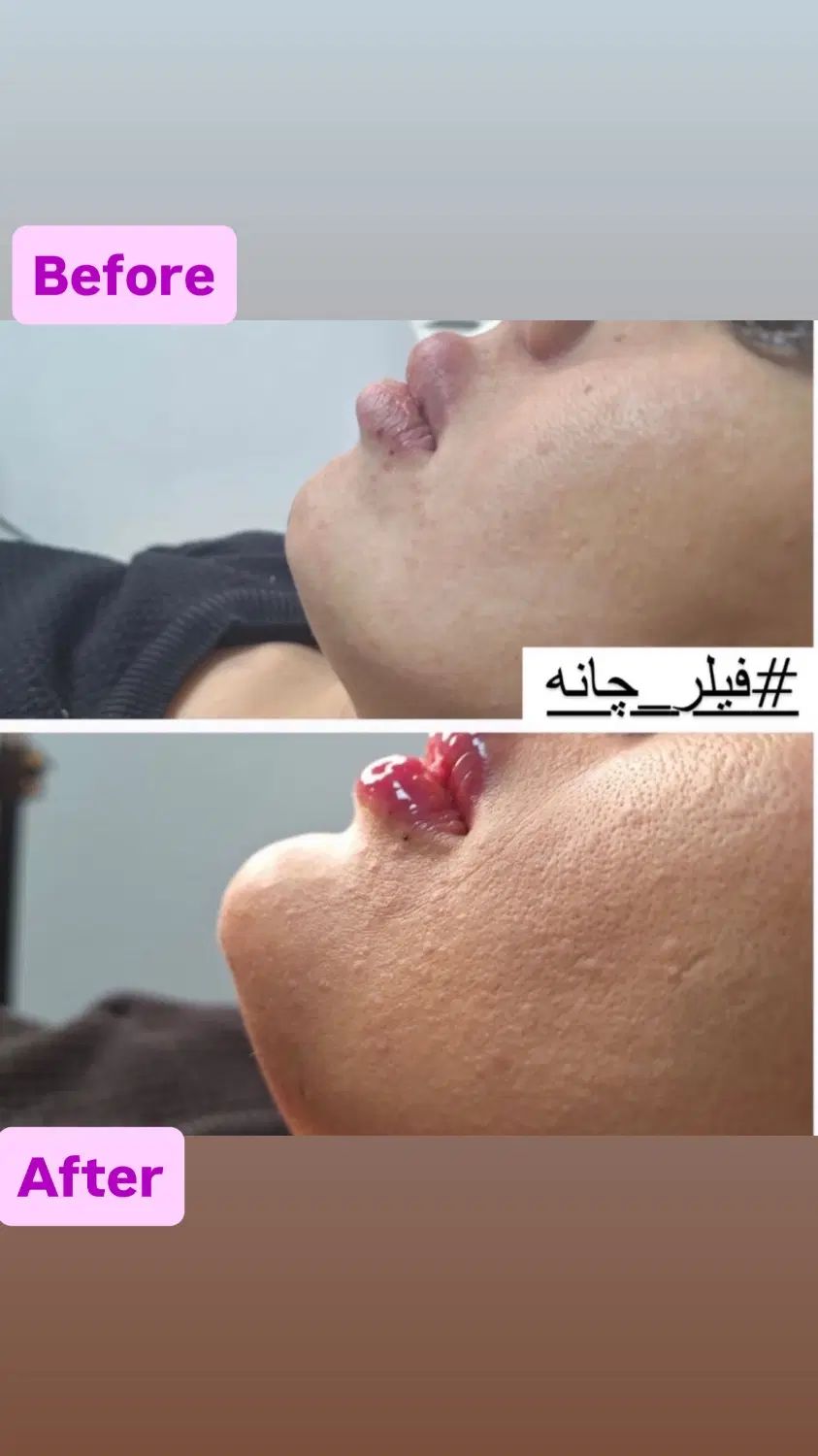 تزریق ژل وبوتاکس تخفیف ویژه|خدمات آرایشگری و زیبایی|تهران, خانی آباد نو شمالی|دیوار