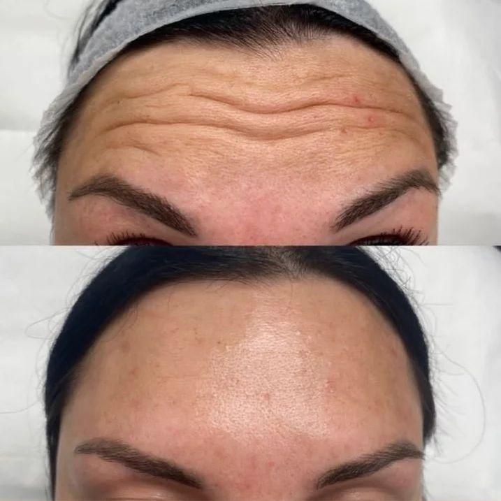 اموزش. بوتاکس فول فیس چشم گربه ای لیفت شقیقه|خدمات آرایشگری و زیبایی|خرم‌آباد, |دیوار