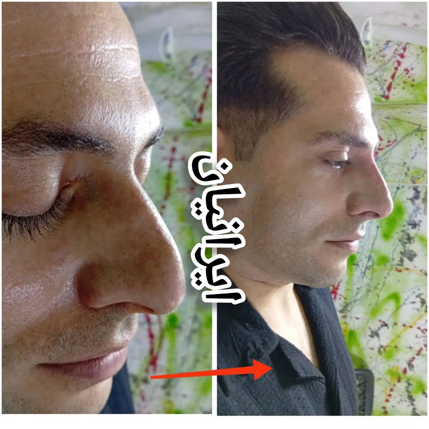خال،فیلر،بوتاکس،انزیم،تخفیف ۵۰درصدی جشنواره ای|خدمات آرایشگری و زیبایی|کرمانشاه, |دیوار