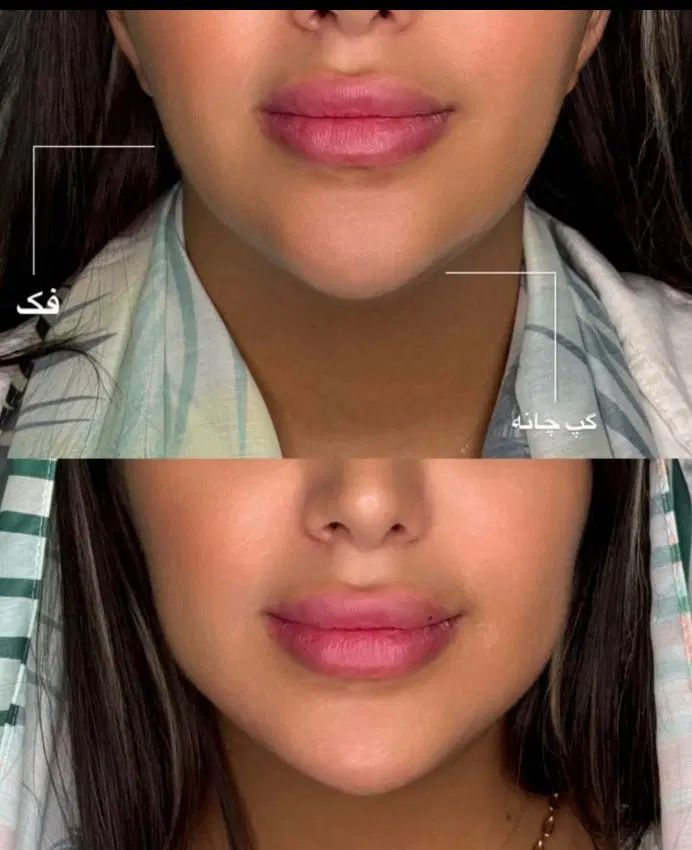 لیزرموهای زائد فول دست پا صورت ژل فیلربادی بوتاکس|خدمات آرایشگری و زیبایی|کرج, گوهردشت|دیوار
