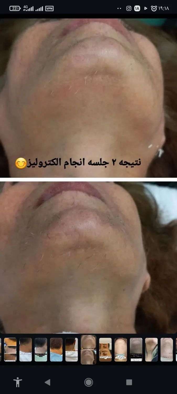 الکترولیز روشی قطعی حذف موهای زائد صورت|خدمات آرایشگری و زیبایی|اشنویه, |دیوار