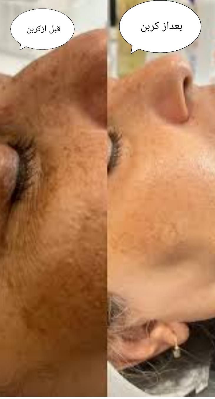 پاککردن تتوی بدن و روشن شدن بیکینی و زیربغل وصورت|خدمات آرایشگری و زیبایی|یاسوج, |دیوار