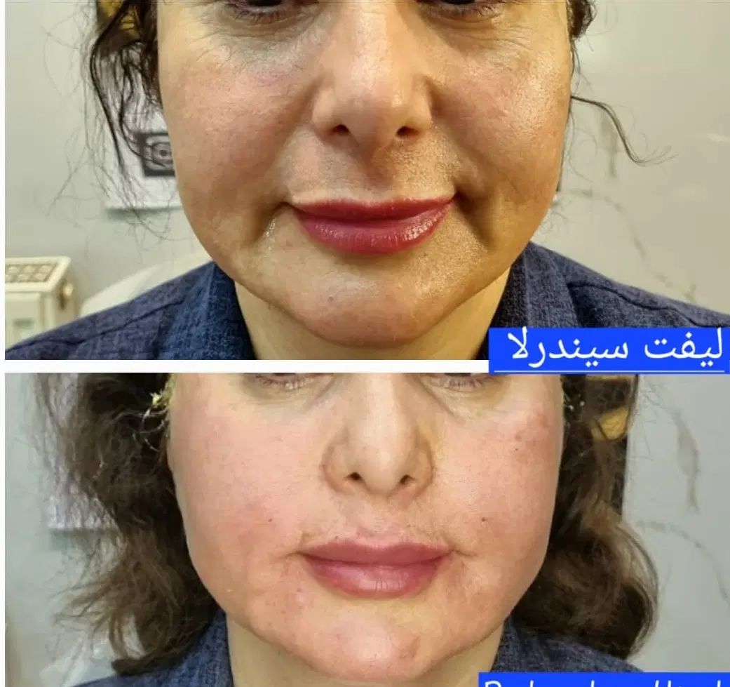 ژل بوتاکس فیلر نخ  فشیال صورت|خدمات آرایشگری و زیبایی|تبریز, |دیوار