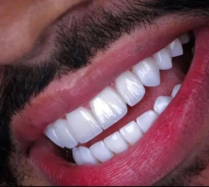 کامپوزیت دندان با چک . اقساط دندانپزشکی . تخفیفات|خدمات آرایشگری و زیبایی|تهران, صادقیه|دیوار