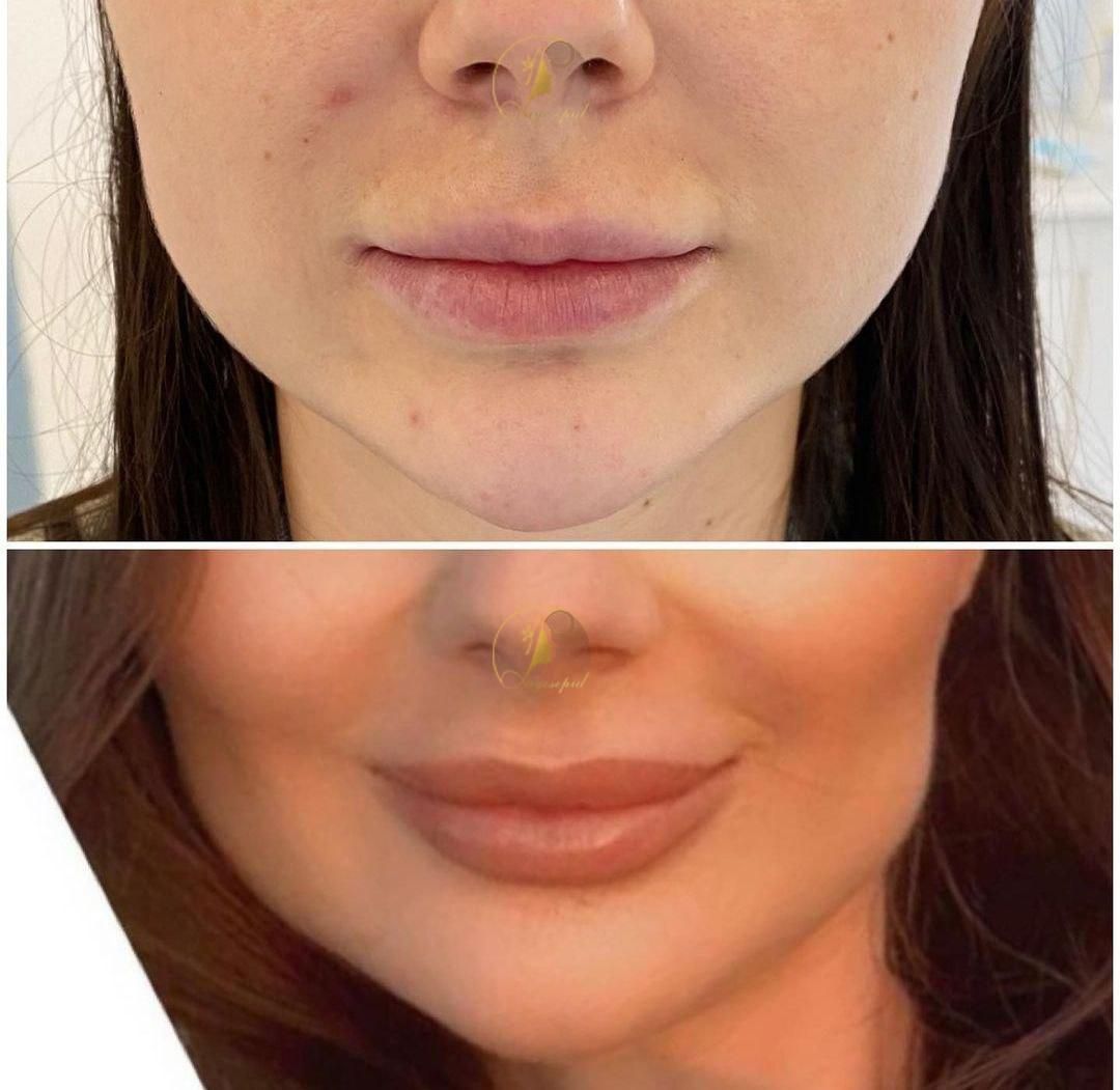 کاشت ابروعمل پلک لیفت کانتور بوکال لیپو غبغب، ژل|خدمات آرایشگری و زیبایی|کرج, عظیمیه|دیوار