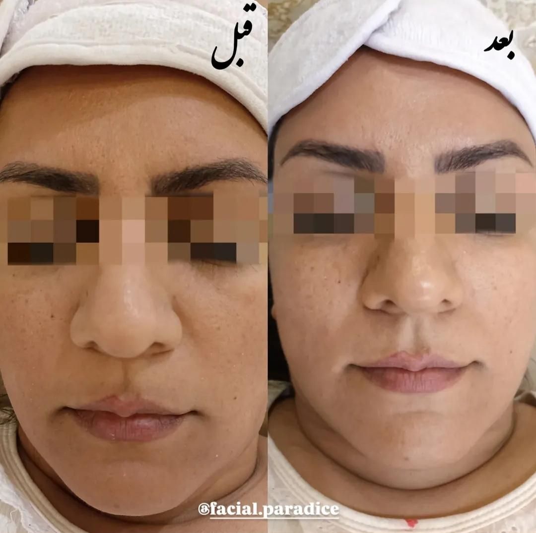 آموزش و پاکسازی و فیشیال تخصصی پوست|خدمات آرایشگری و زیبایی|مشهد, فارغ التحصیلان|دیوار