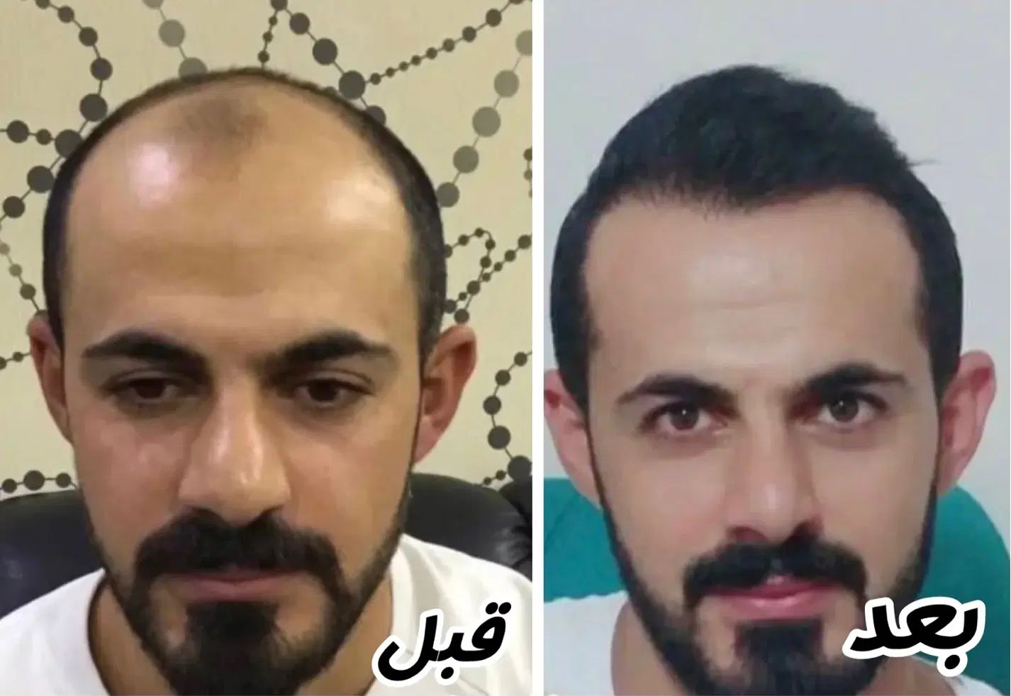کاشت تخصصی مو سوپرمیکروگرفت با شرایط ویژه|خدمات آرایشگری و زیبایی|اردبیل, |دیوار
