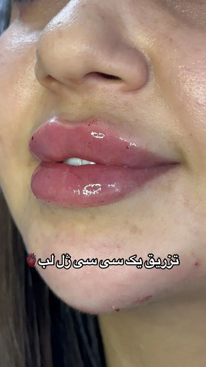 آموزش  و ارائه  ژل و بوتاکس و مزو|خدمات آموزشی|شیراز, سینما سعدی|دیوار