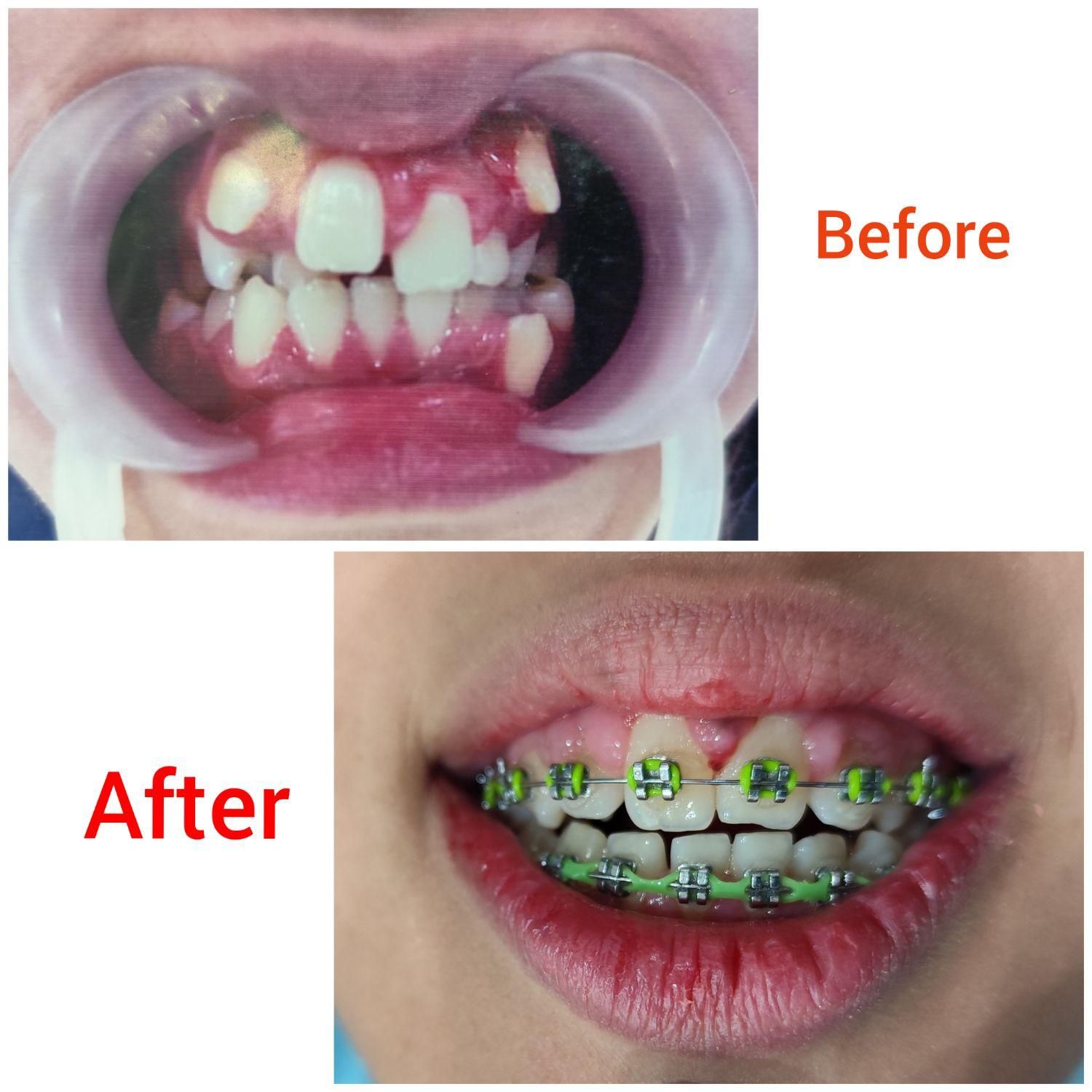 ارتودنسی لبخندی زیبا(فقط تا آخر ماه)|خدمات آرایشگری و زیبایی|مشهد, آزادشهر|دیوار