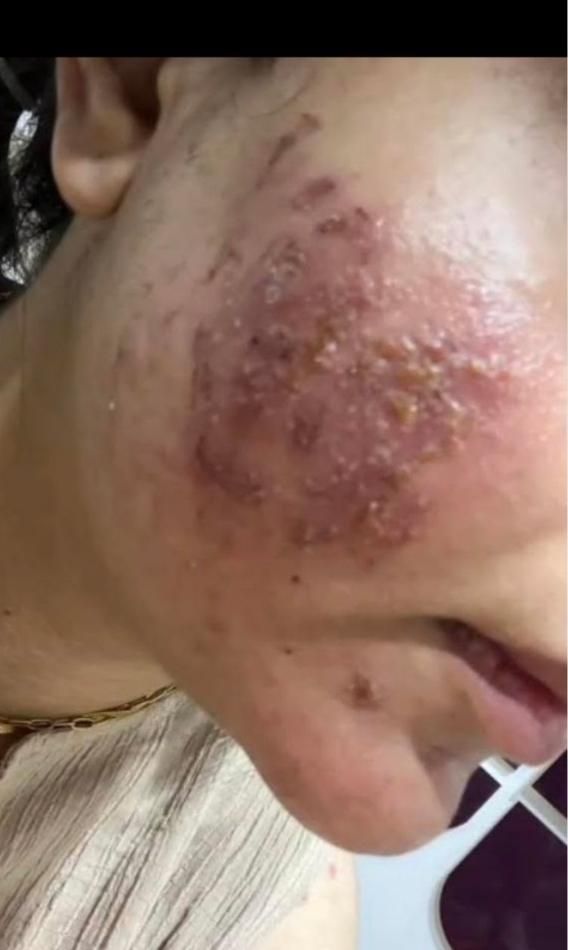 درمان جوش با هر منشایی|خدمات آرایشگری و زیبایی|دوگنبدان, |دیوار