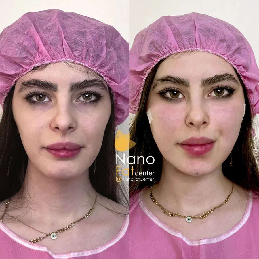 تزریق چربی صورت ماندگاری دائمی روی دست بیکینی باسن|خدمات آرایشگری و زیبایی|تهران, صادقیه|دیوار