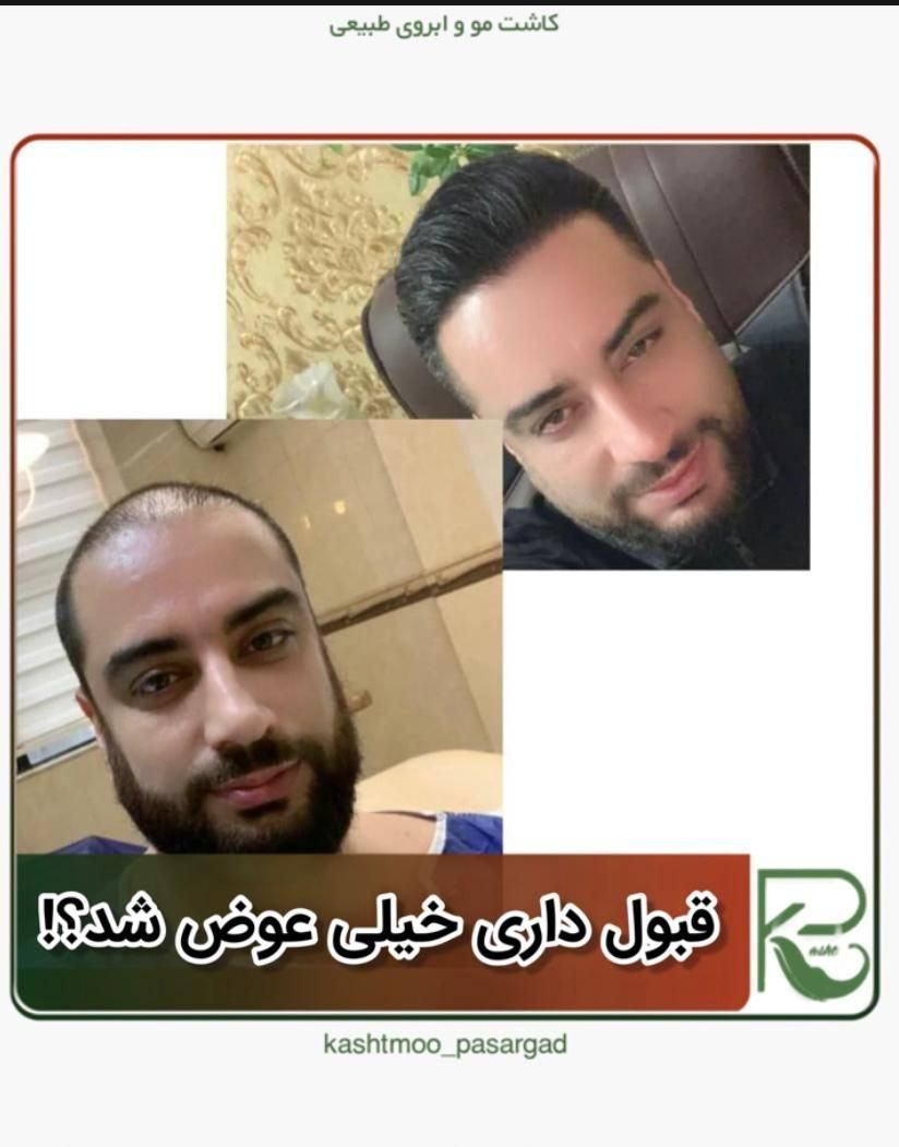کاشت مو و ابرو و ریش تارکوب|خدمات آرایشگری و زیبایی|گلپایگان, |دیوار