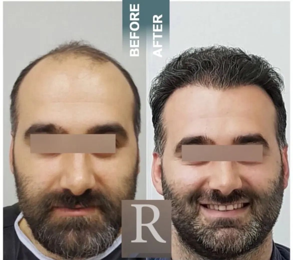 عمل بینی بلفارو پلاستی ساکشن غبغب ابدو ساکشن|خدمات آرایشگری و زیبایی|مشهد, ملک‌آباد|دیوار