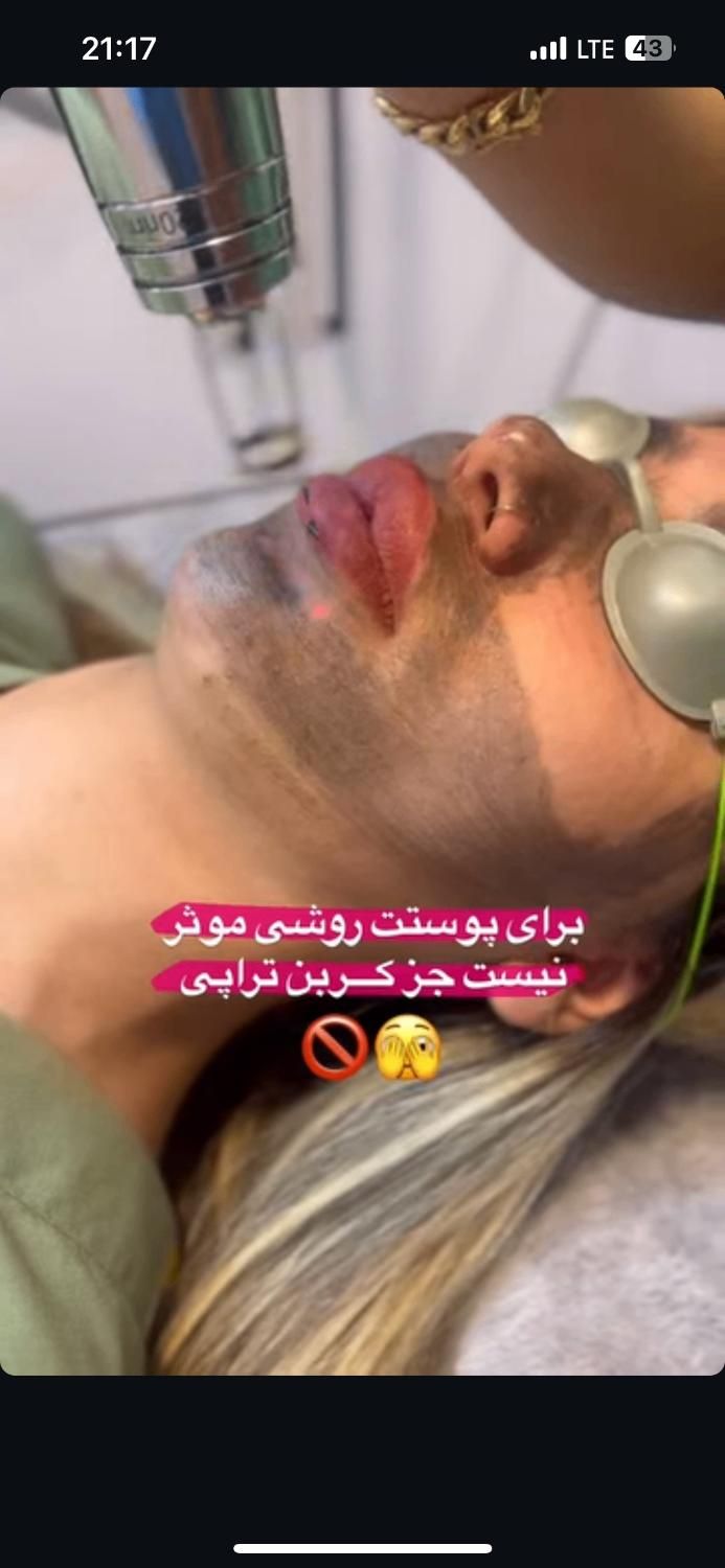 ریموو تاتو/ریزش سکه ای/مزوتـراپی/خال بـرداری/فیشال|خدمات آرایشگری و زیبایی|شیراز, طلاب|دیوار