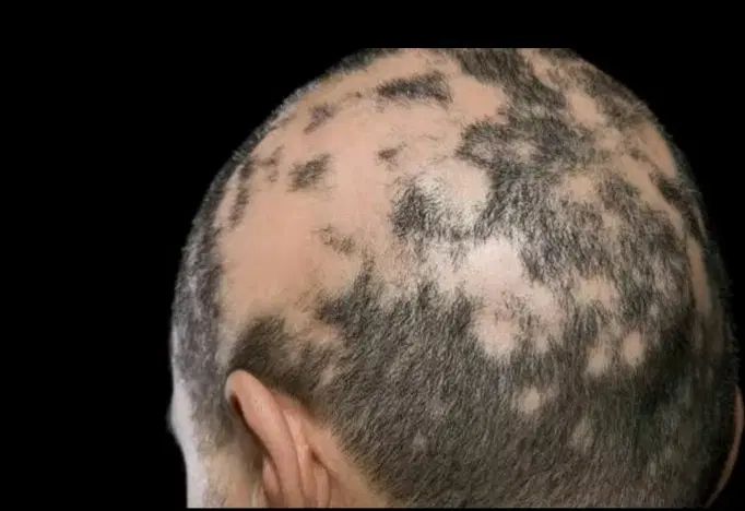 دیگه با ریزش موهات خداحافظی کن|آرایشی، بهداشتی، درمانی|کرج, عظیمیه|دیوار