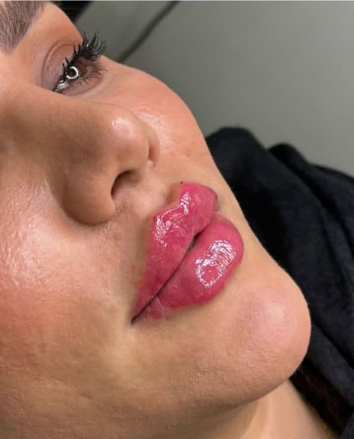 تزریق ژل و بوتاکس لیفت نخ جدیدترین متد مطب زیبایی|خدمات آرایشگری و زیبایی|کرج, گوهردشت|دیوار