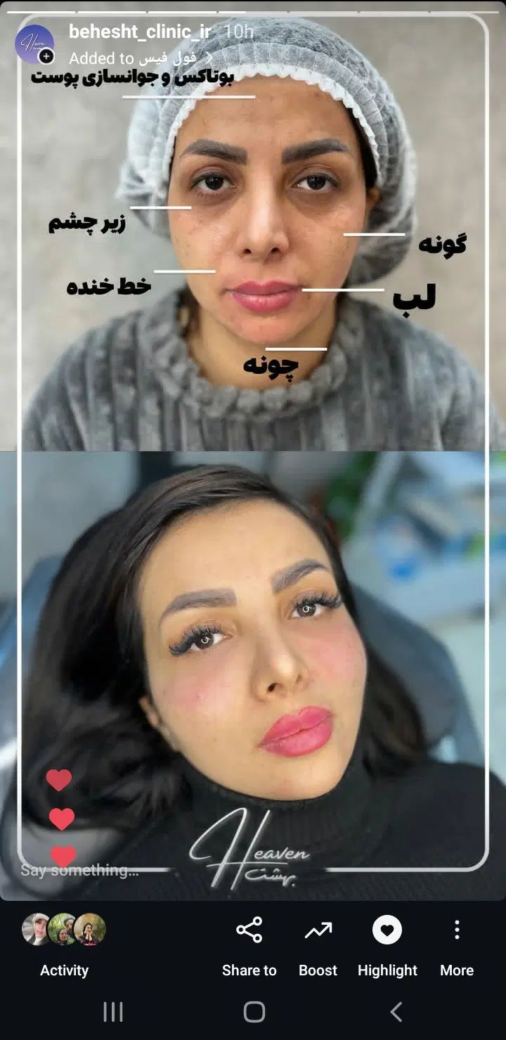 prp پی ارپی ژل فیلر بوتاکس نخ لیزر فیشیال هایفو|خدمات آرایشگری و زیبایی|مشهد, هفت تیر (حافظ)|دیوار