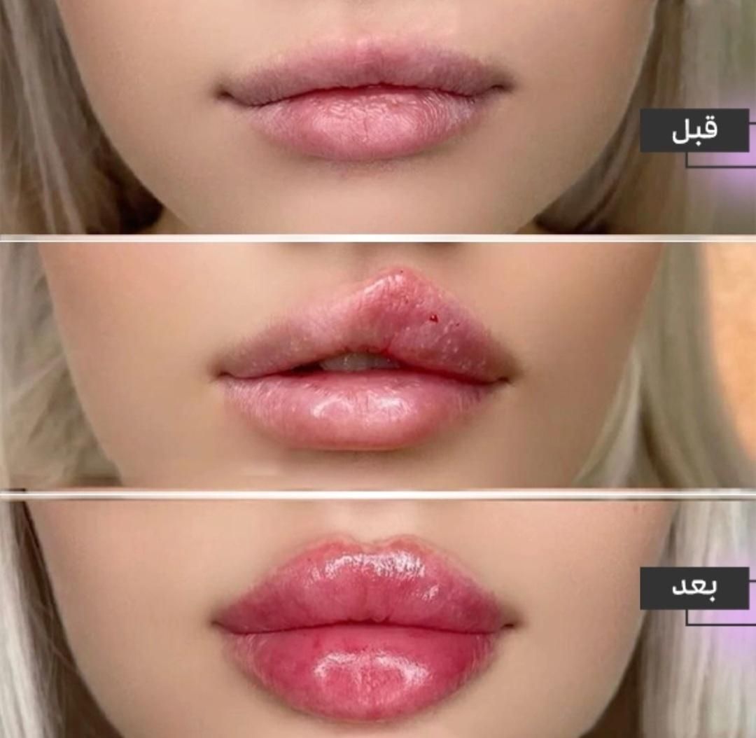 ژل و بوتاکس فشیال،پی آر پی مو زانو صورت،لیزر مو|خدمات آرایشگری و زیبایی|کرج, گوهردشت|دیوار