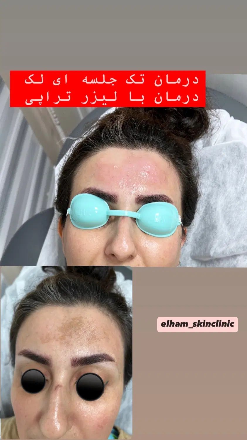 کلینیک لیزرموهای زائدالکساندرایت پلاس شاتی(هوشمند)|خدمات آرایشگری و زیبایی|رشت, گلسار|دیوار