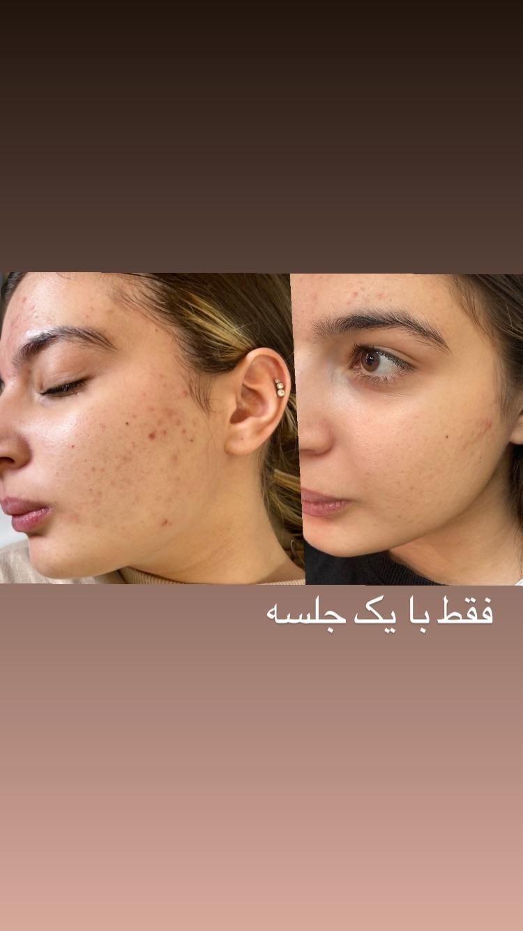 فشیال پاکسازی لیزر پوست جوانساز|خدمات آرایشگری و زیبایی|شیراز, معالی‌آباد|دیوار