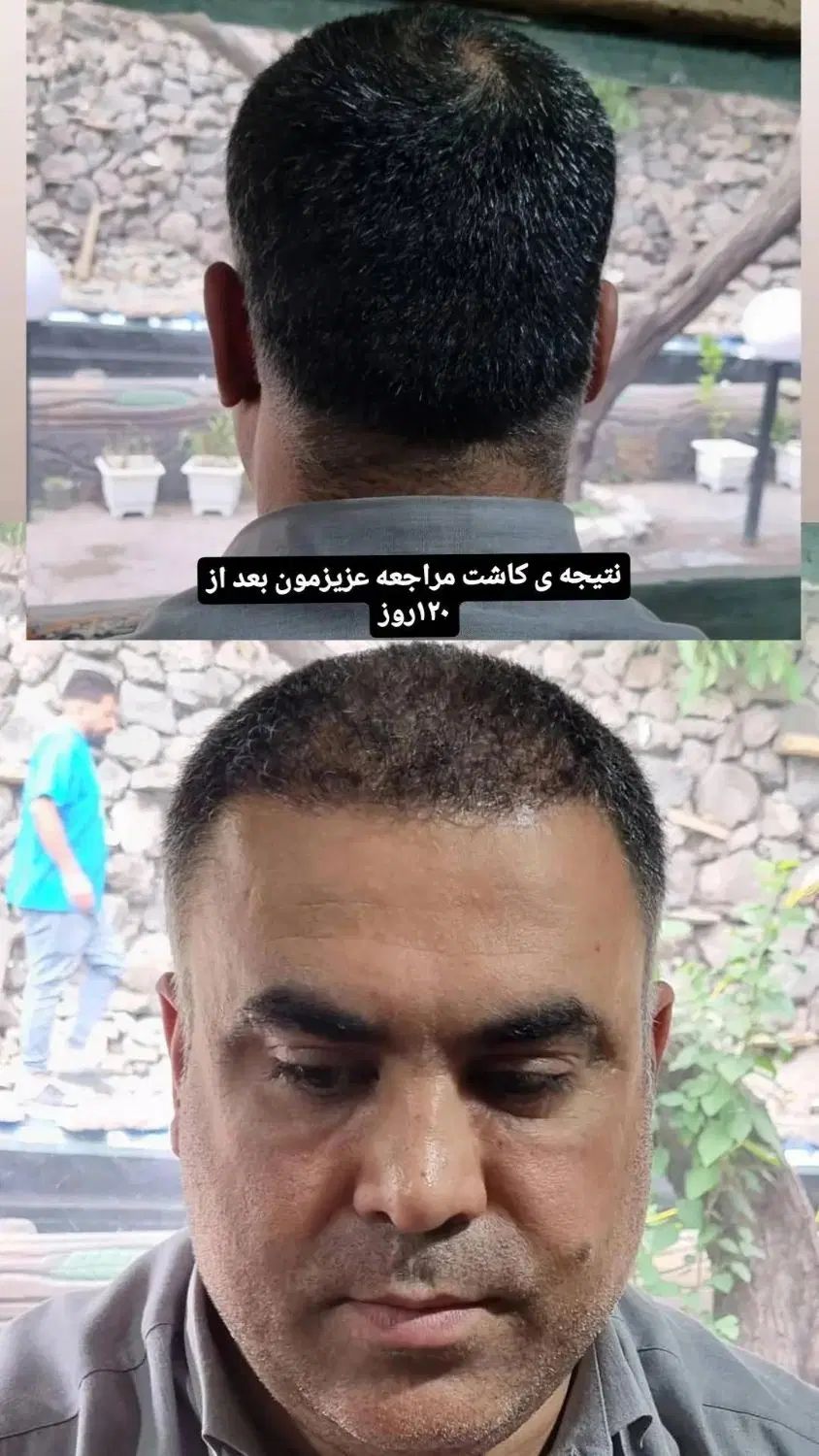 کاشت مو ابرو لیزر ژل بوتاکس مزو واکسن زگیل تناسلی|خدمات آرایشگری و زیبایی|اندیشه, اندیشه فاز ۱|دیوار