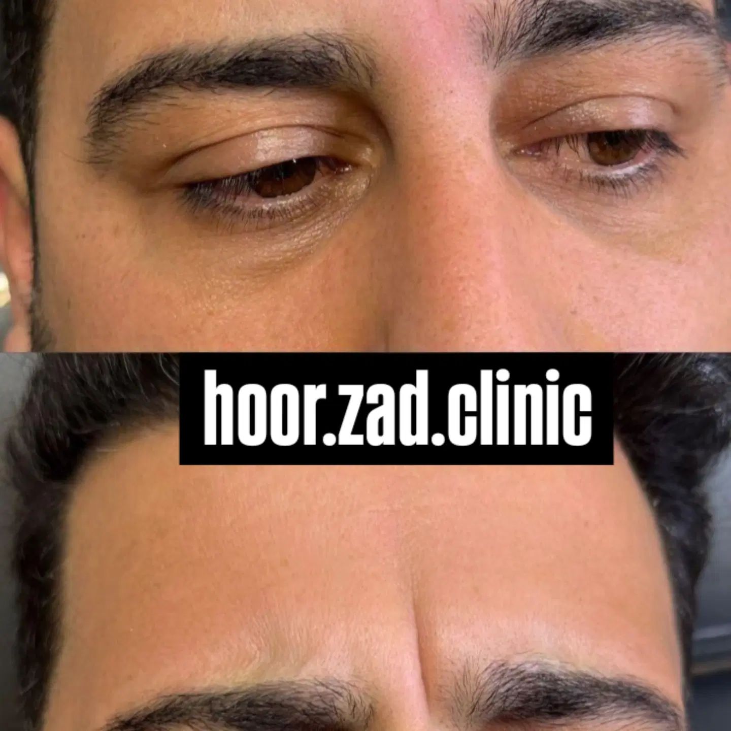 جشنواره پاییزه و افتتاح کلینیک بوتاکس وفیلر|خدمات آرایشگری و زیبایی|ارومیه, |دیوار
