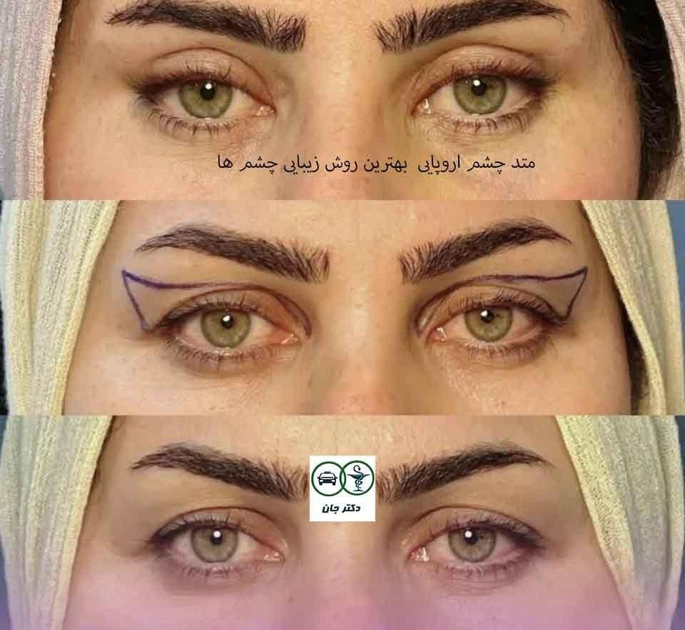 برداشتن پف بالا و پایین چشم متداروپایی|خدمات آرایشگری و زیبایی|اصفهان, جلفا|دیوار
