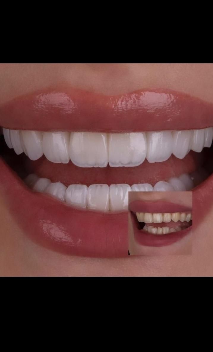 دندانپزشکی زیبایی روکش کامپوزیت عصبکشی ترمیم دندان|خدمات آرایشگری و زیبایی|تبریز, |دیوار