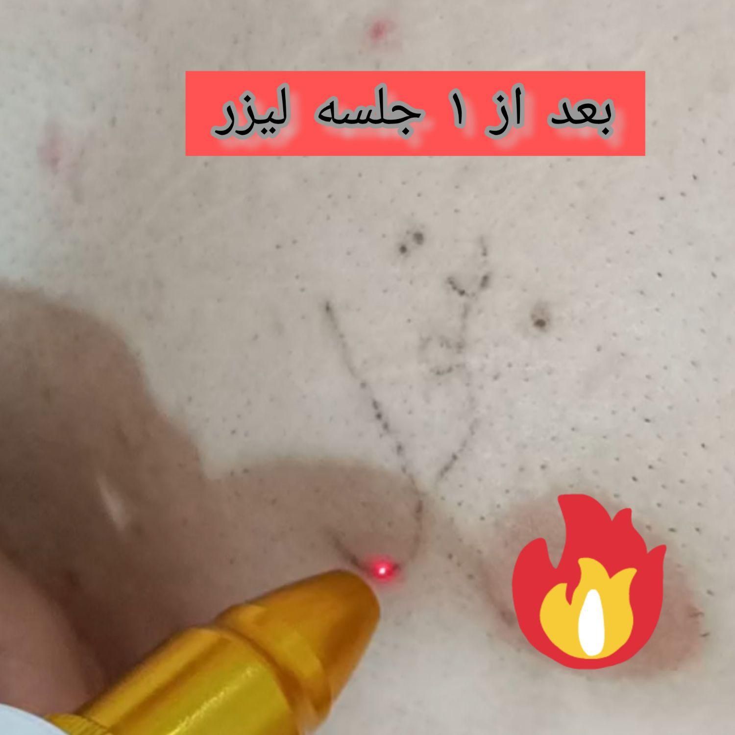 لیزر تاتو و خالکوبی و جوانسازی پوست(کر۰بنتراپی)|خدمات آرایشگری و زیبایی|محمدشهر, |دیوار