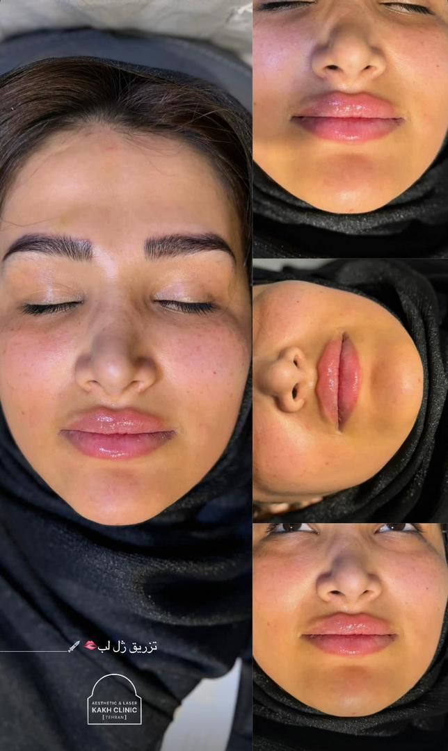 نیازمند مدل خانم برای فیلر،بوتاکس و...بدون پرداختی|خدمات آرایشگری و زیبایی|تهران, قلهک|دیوار