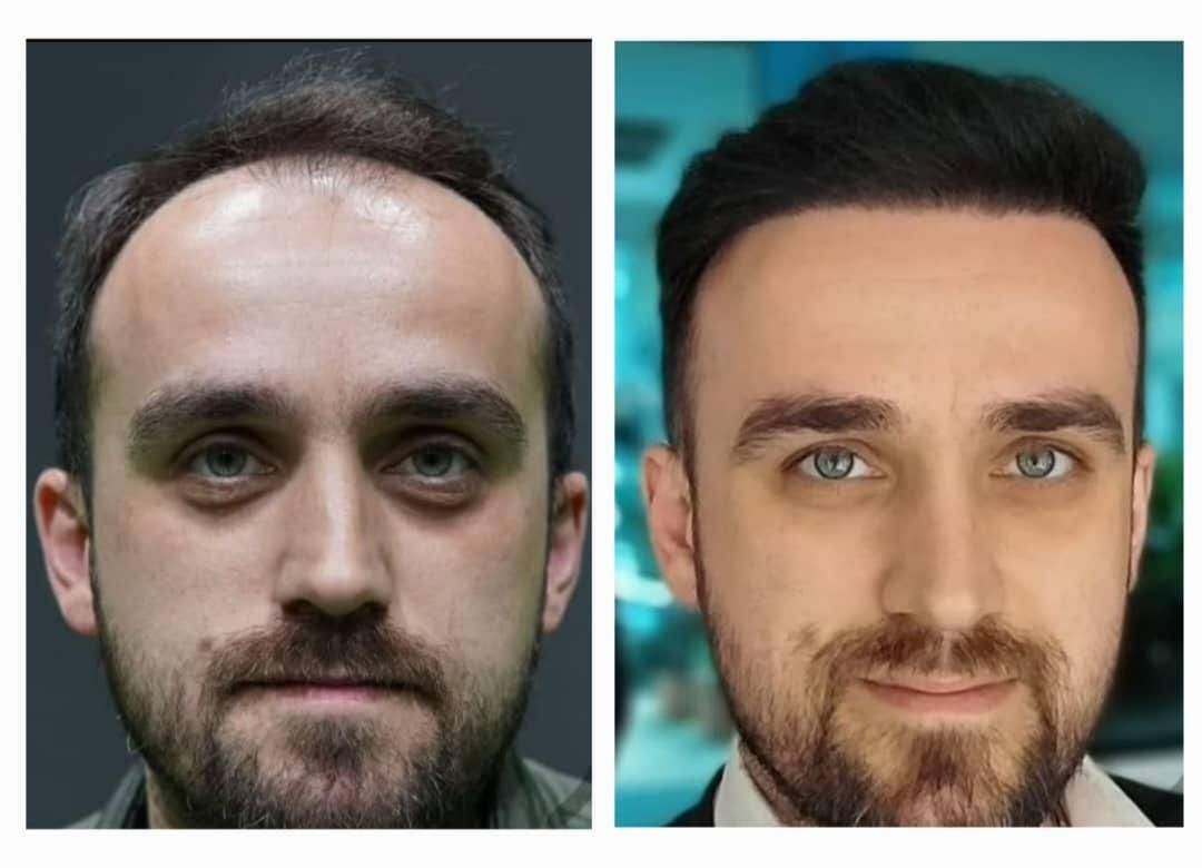 کاشت مو طبیعی،ابرو،و ریش بدون ورم و حتی کبودی|خدمات آرایشگری و زیبایی|یاسوج, |دیوار