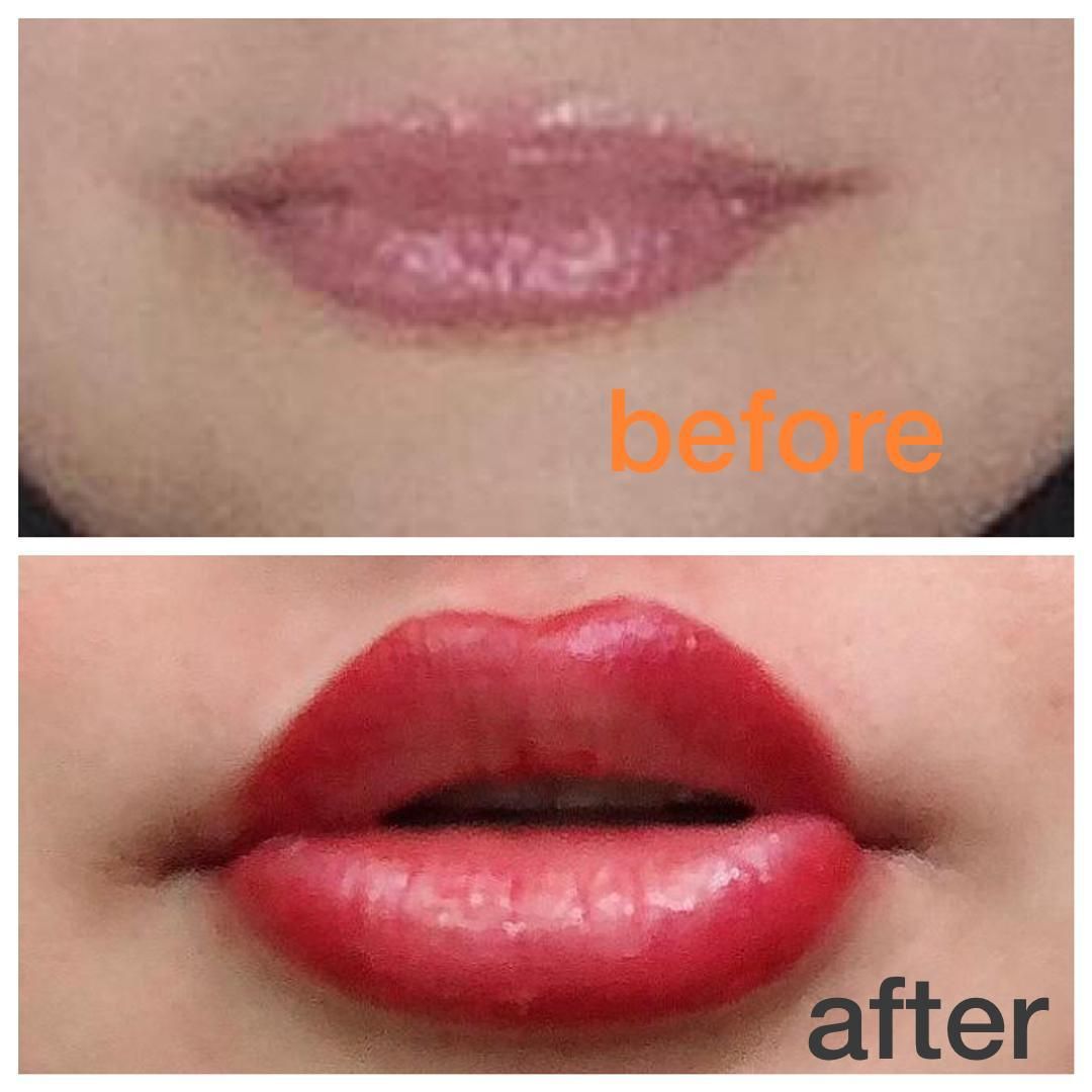 تزریق ژل و بوتاکس، لیزر موهای زائد، لاغری تضمینی|خدمات آرایشگری و زیبایی|رشت, دیلمان|دیوار