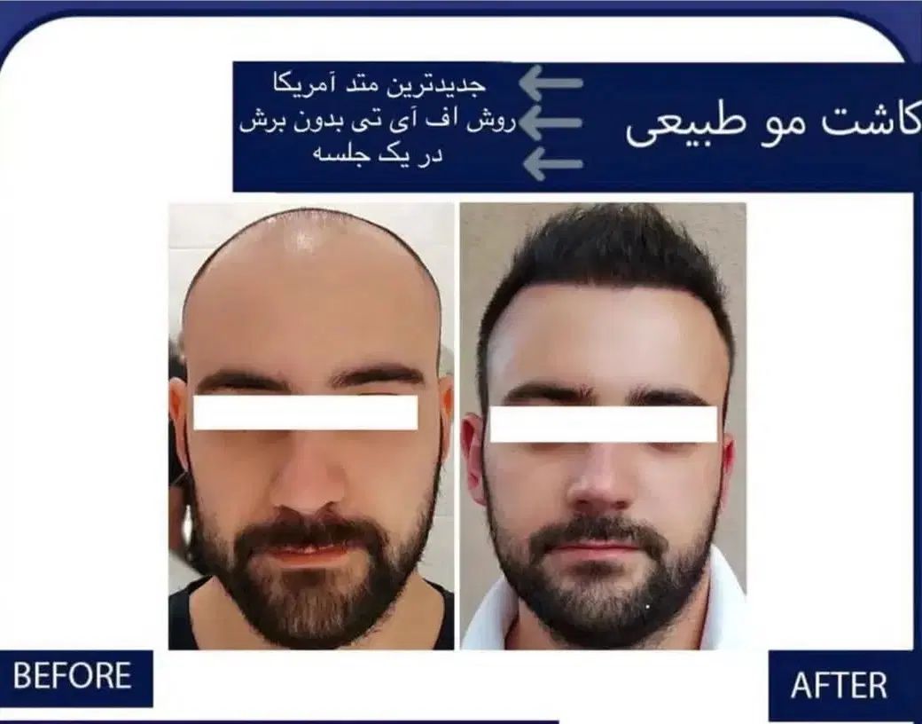 کاشت مو و ابرو طبیعی|خدمات آرایشگری و زیبایی|اصفهان, شاهزید|دیوار