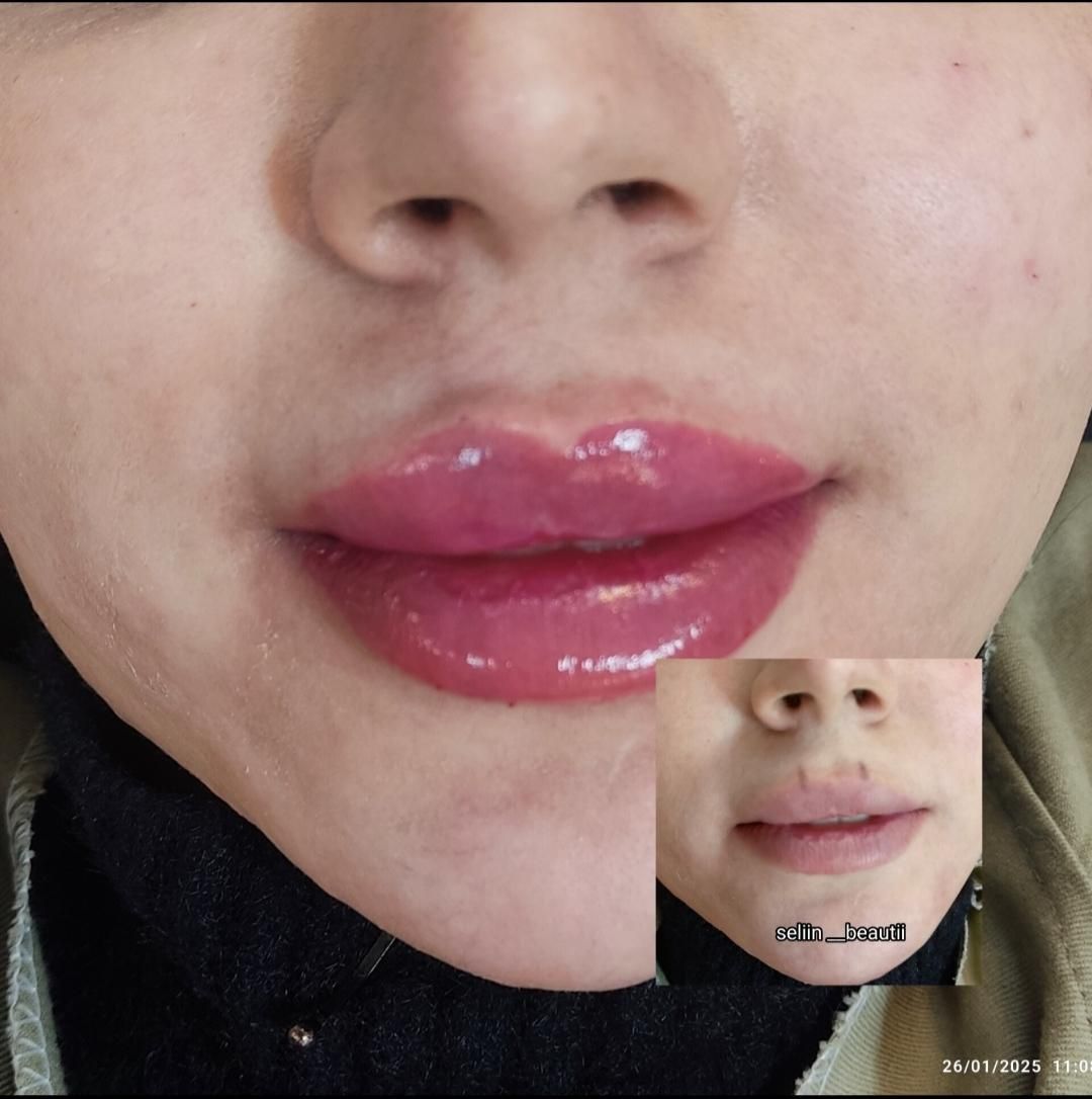 ژل وبوتاکس.چربی سوز.انزیم.فشیال.پیرسینگ|خدمات آرایشگری و زیبایی|اصفهان, احمدآباد|دیوار