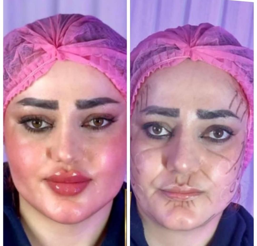 جشنواره باور نکردنی ویژه. ژل و بوتاکس.فیلر مزو ژل|خدمات آرایشگری و زیبایی|شیراز, سینما سعدی|دیوار