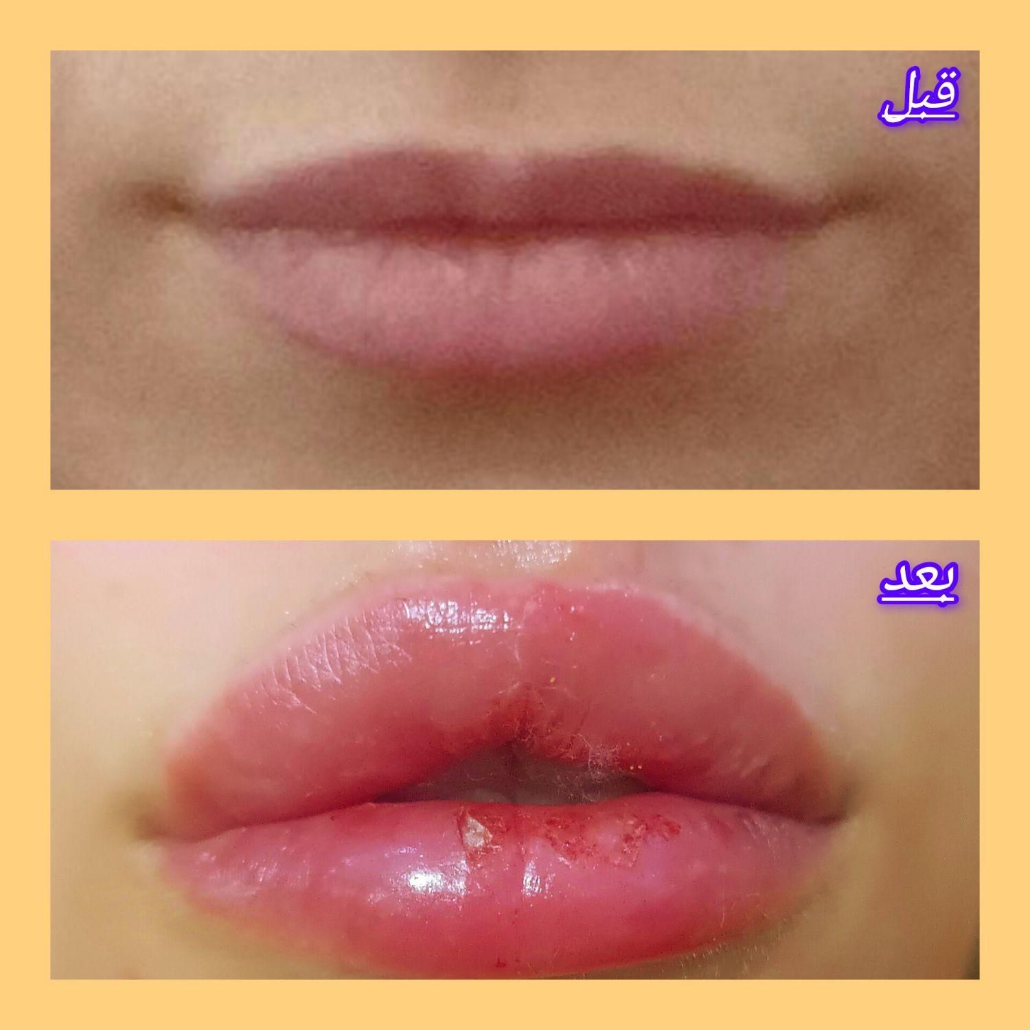 جشنواره تزریق ژل و بوتاکس وانزیم|خدمات آرایشگری و زیبایی|ملارد, |دیوار