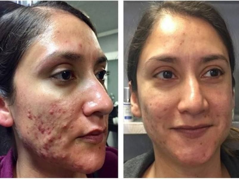 فیشال(پاکسازی) اقتصادی صورت vip|خدمات آرایشگری و زیبایی|محمدیه-قزوین, |دیوار