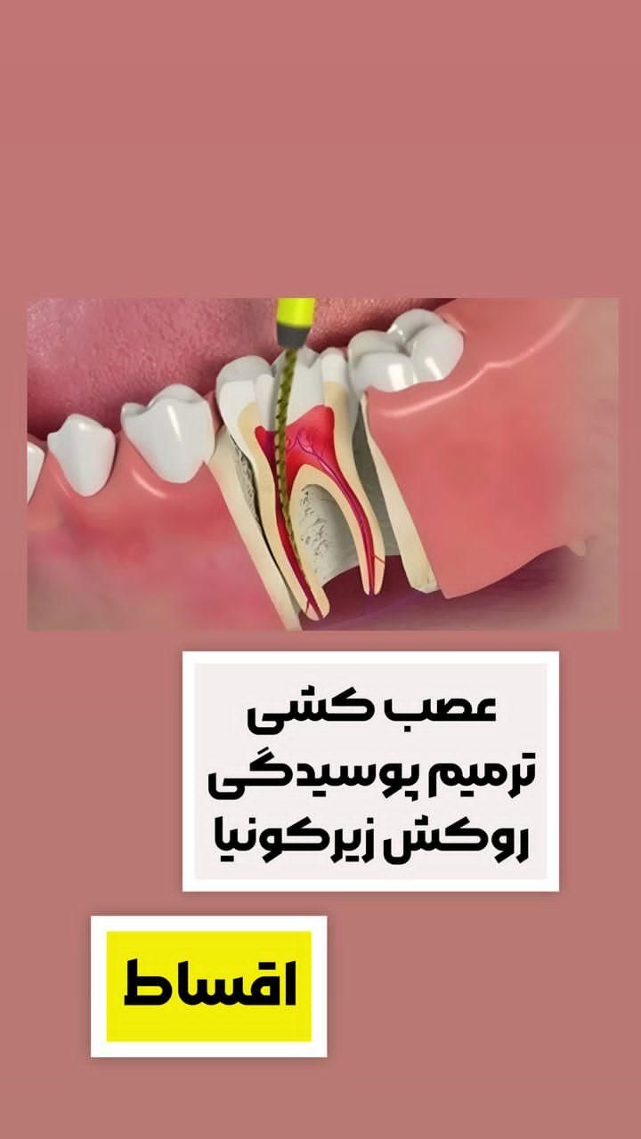 دندانپزشکی ((اقساط)) کامپوزیتـ ایمپلنت عصب کشی|خدمات آرایشگری و زیبایی|قدس, شهر‌قدس|دیوار