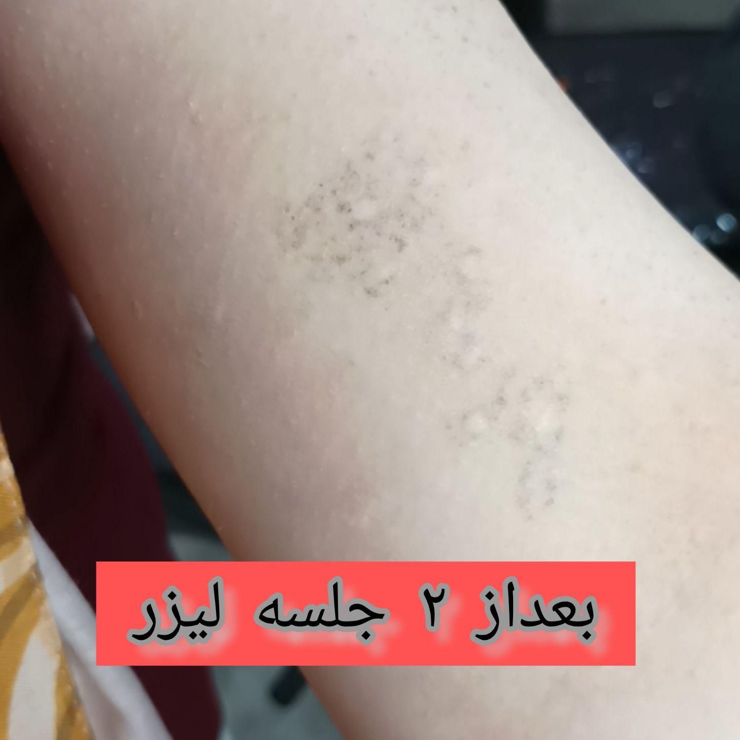 لیزر تاتو و خالکوبی و جوانسازی پوست(کر۰بنتراپی)|خدمات آرایشگری و زیبایی|محمدشهر, |دیوار