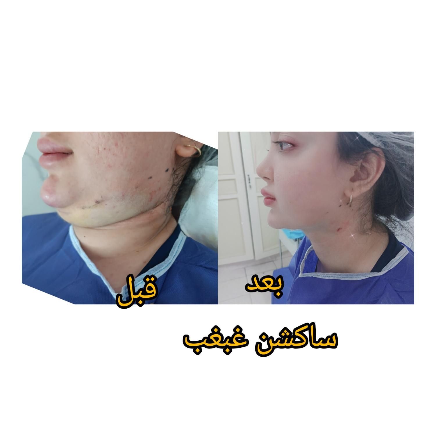 ساکشن چربی بلفاروپلاستی لابیاپلاستی ژل بوتاکس|خدمات آرایشگری و زیبایی|شیراز, ملاصدرا|دیوار