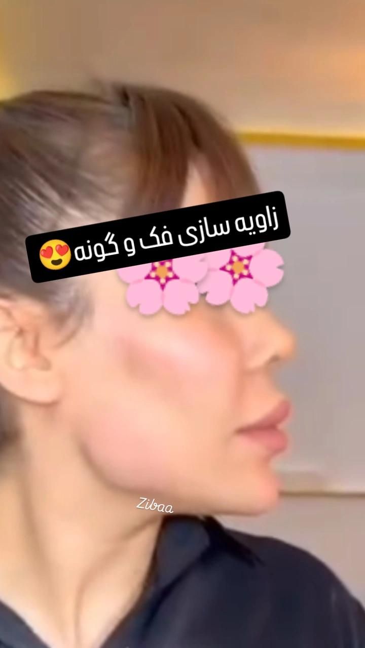 ژل و بوتاکس|خدمات آرایشگری و زیبایی|کرمانشاه, |دیوار